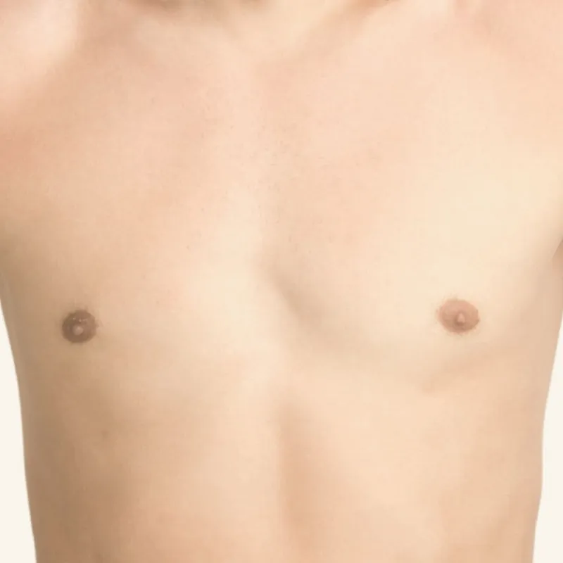 Depilación láser de areolas para hombre