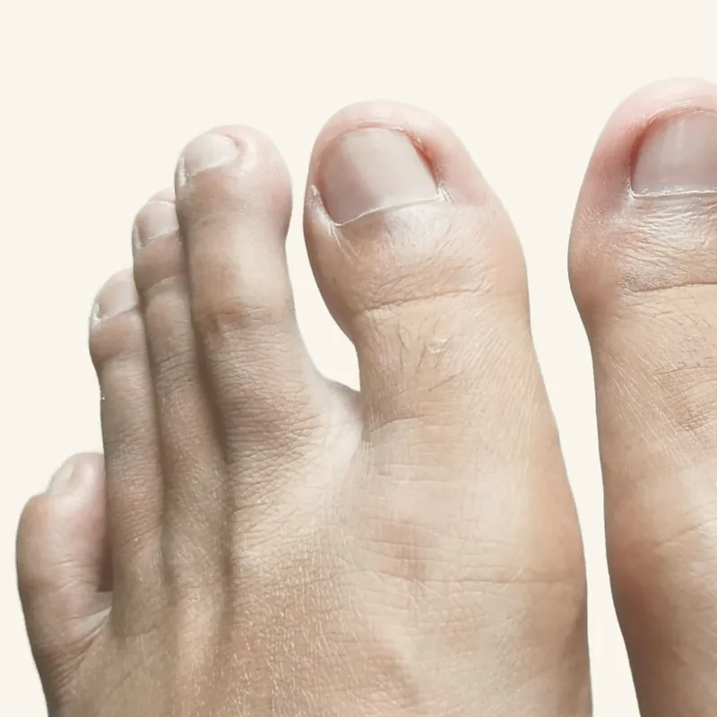 Depilación láser de dedos de pies o manos para hombre