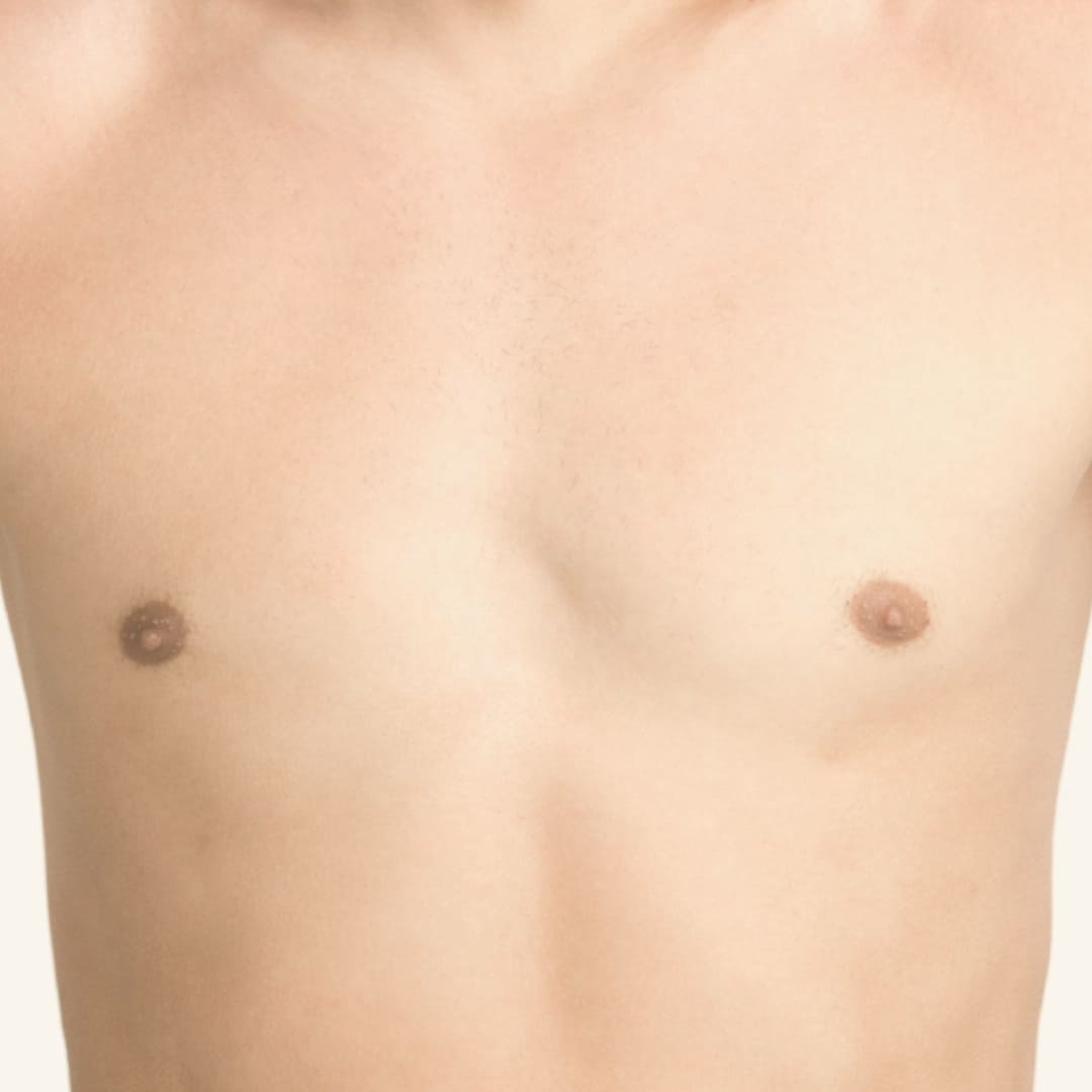 depilación láser hombre - areolas depilación láser hombre - areolas