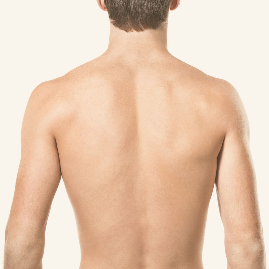 depilación láser hombre - espalda depilación láser hombre - espalda