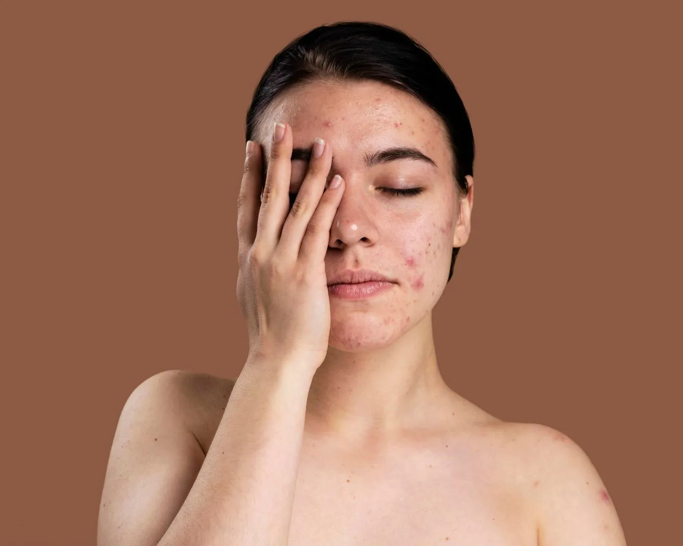 radiance_blog_portada_marcas_de_acne_y_piel_sensible