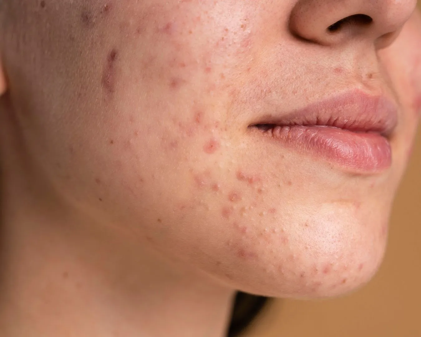 radiance_blog_portada_una_limpieza_facial_para_manchas_puede_transformar_tu_rostro